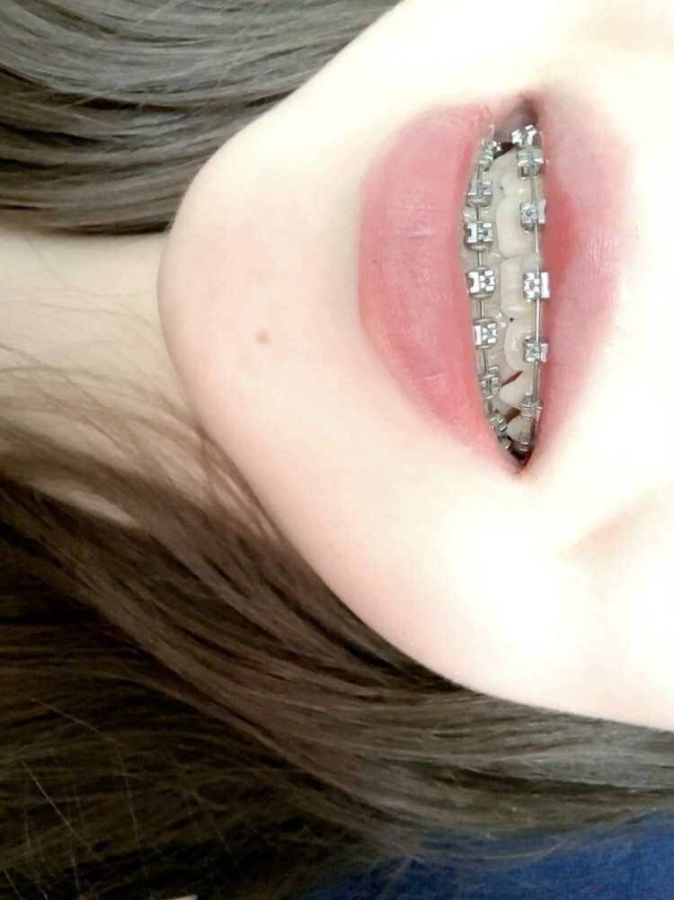 Brackets Braces Estetic False no repair Just Cosmetic
