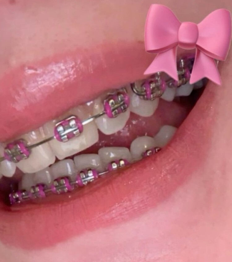 Brackets Braces Estetic False no repair Just Cosmetic